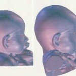 Update after 2.5 months in the baby helmet! With before and after laser scan images